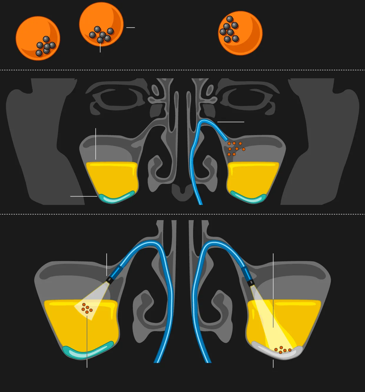 Microscopic Robots Revolutionizing Sinus Treatment